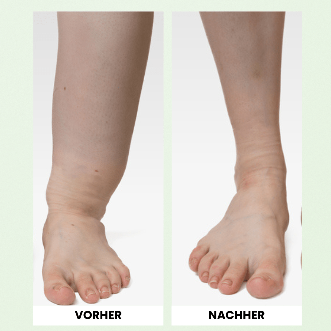 OrthoMax® Thérapie Lymphatique - Vela Vici 🇫🇷